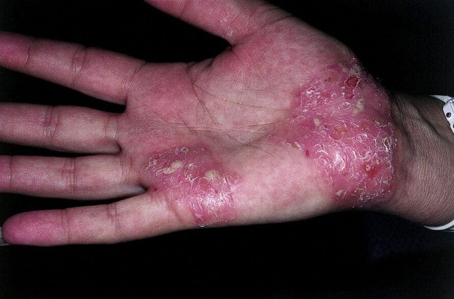 exacerbation of psoriasis in the hands