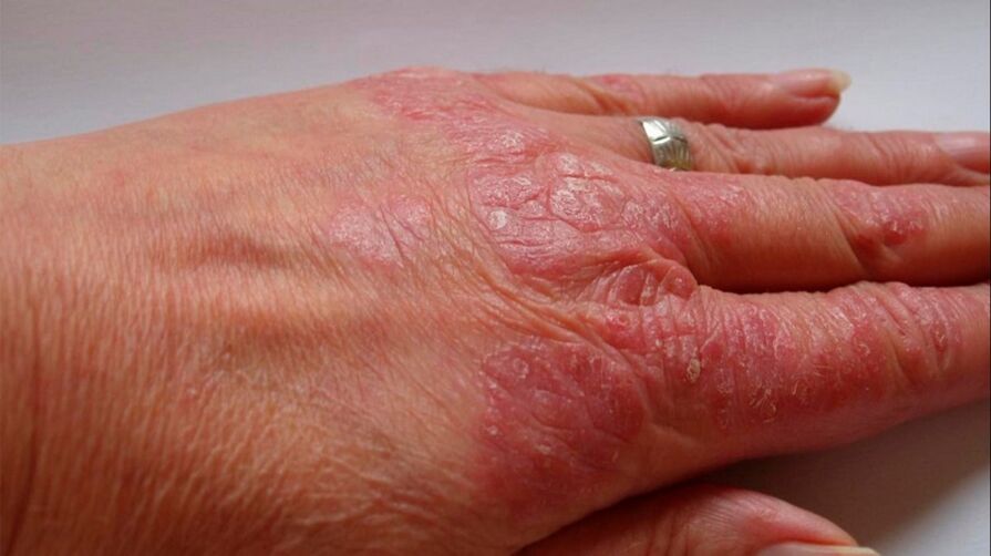 hand psoriasis symptoms