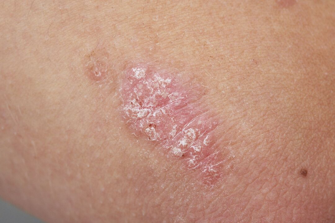 psoriasis on a child's skin