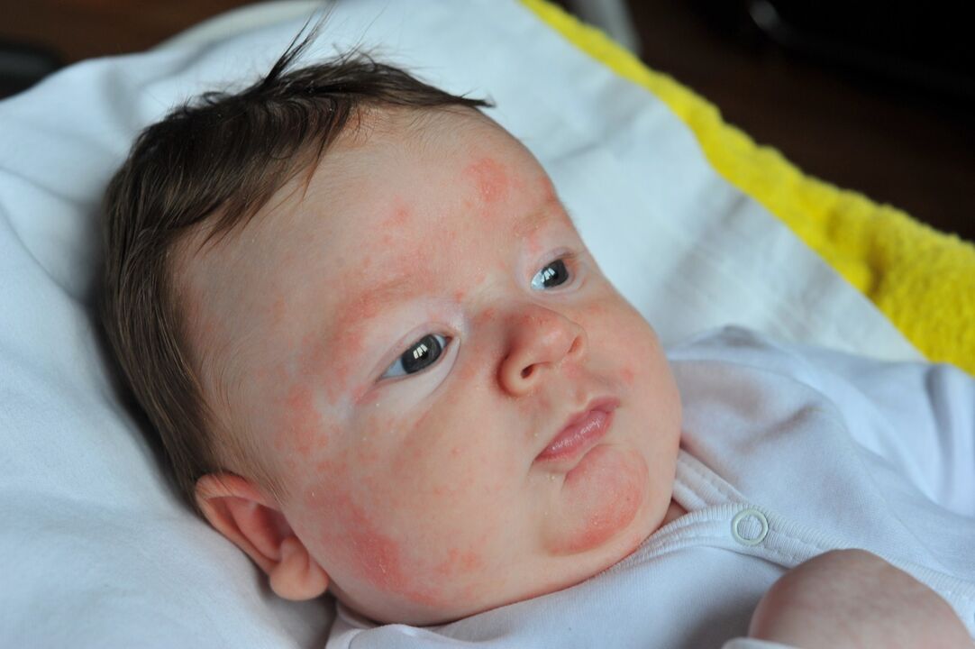 psoriasis symptoms in a child