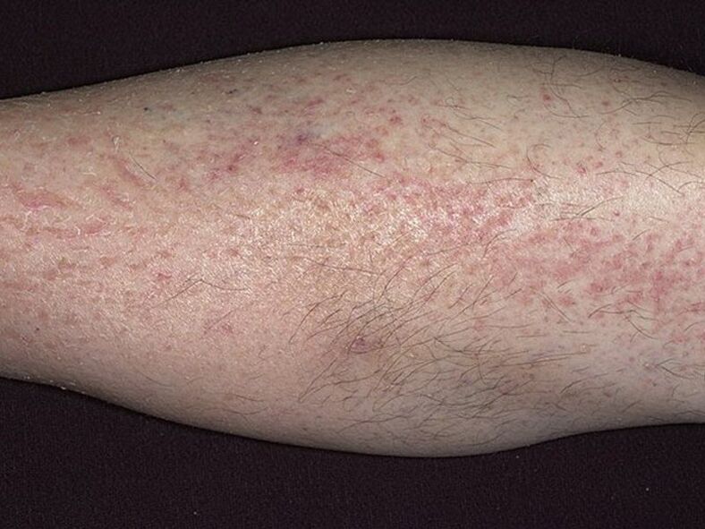 symptoms of psoriasis on legs