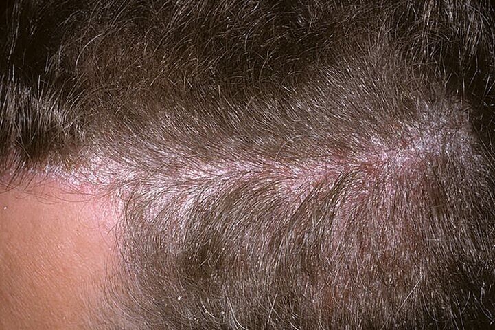 Psoriasis on the head