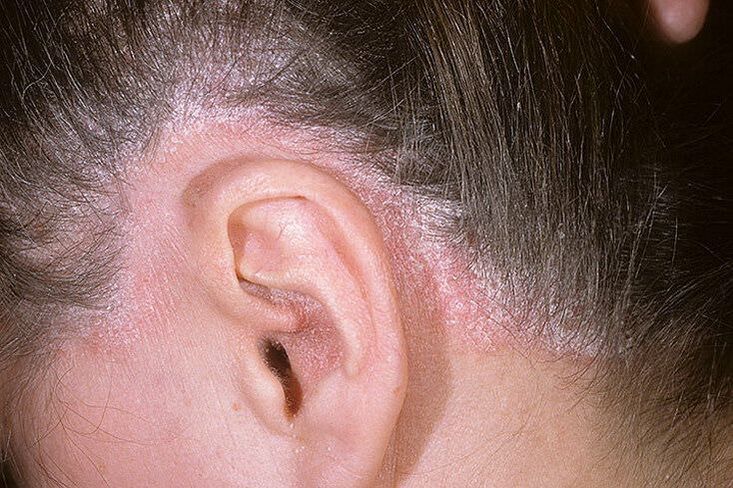 Psoriasis rashes on the head behind the ears