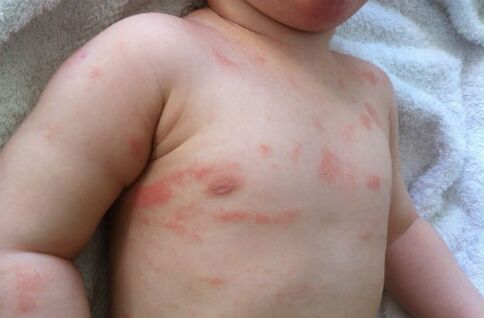 psoriasis symptoms in a child