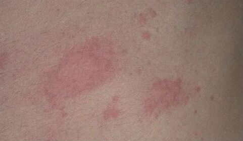 red spots on psoriasis