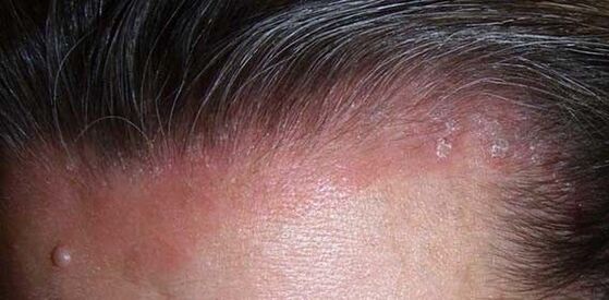 manifestation of psoriasis on the head