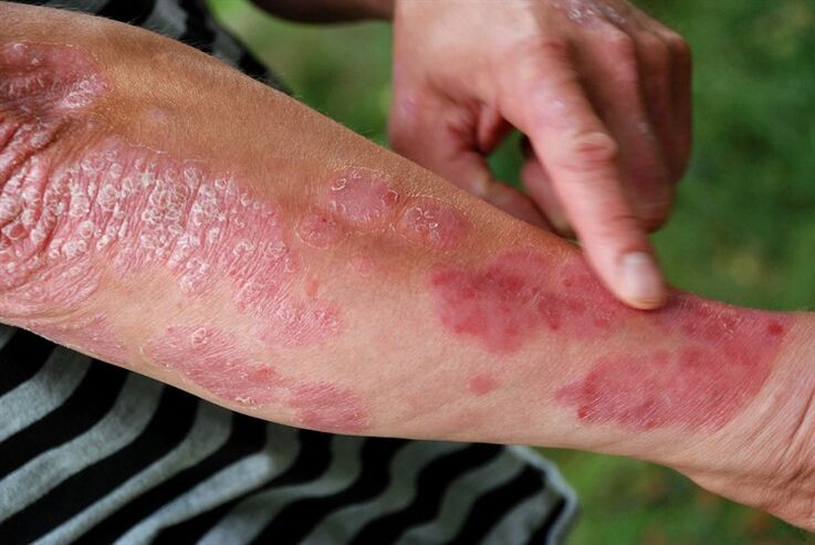 psoriatic patches on arm