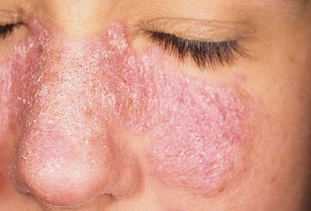 Progressive stage of psoriasis on the skin of the face