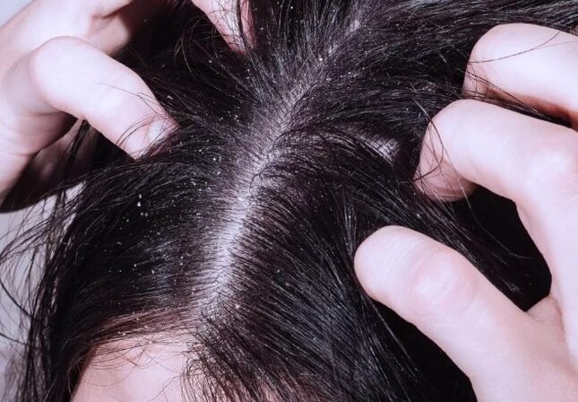 Psoriasis on the head