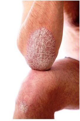 Elbow psoriasis
