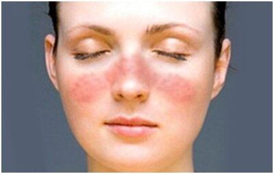 Psoriasis on the face