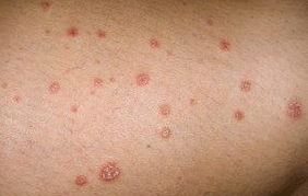 Psoriatic plates