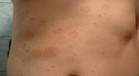 Unhappy psoriasis