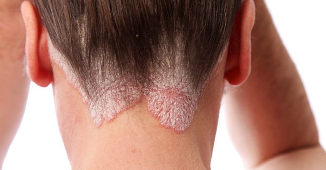 Psoriasis in the girls