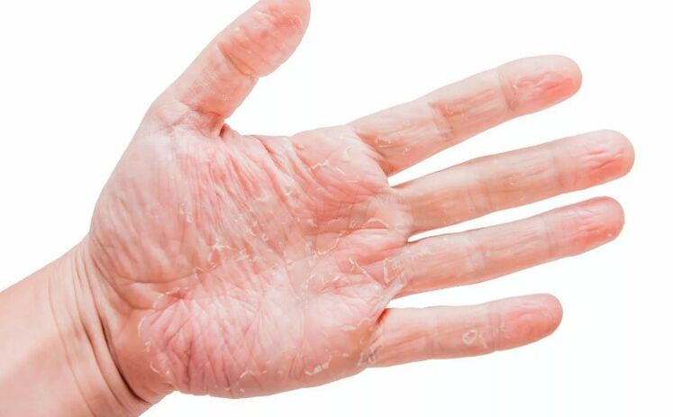 Psoriasis