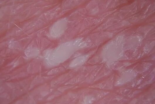 Pustulenia psoriasis