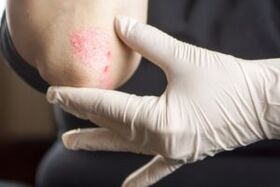 Elbow psoriasis