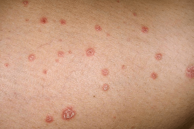 Psoriatic plaques
