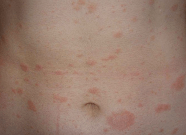 Regressive stage of psoriasis