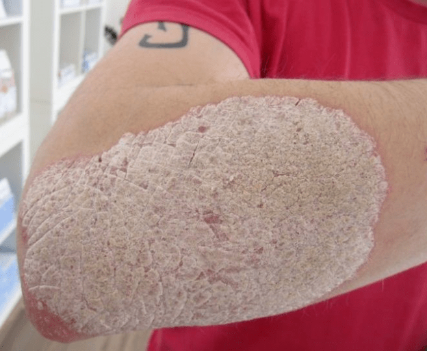 Stationary stage of psoriasis