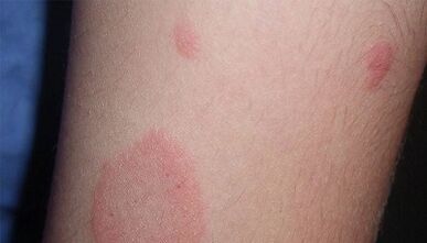 How the initial stage of psoriasis manifests itself