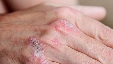symptoms of early stage psoriasis