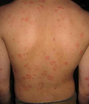 back psoriasis