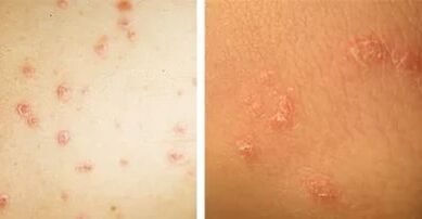 main manifestations of psoriasis