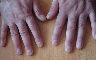 psoriasis symptoms in the initial stage