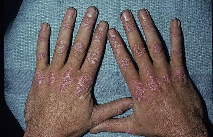 reasons for developing psoriasis on hands