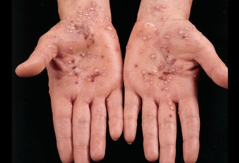 how is psoriasis on the palms