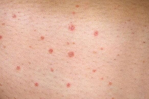 Dotted psoriasis
