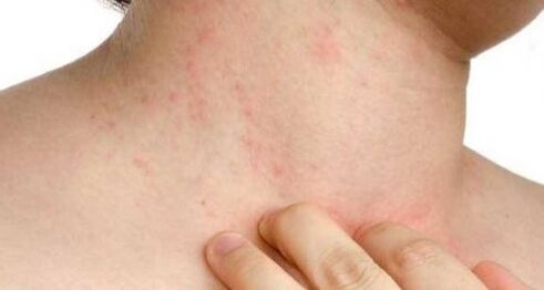 itchy skin in the early stage of psoriasis