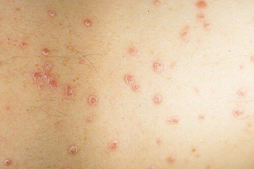 photo of the early stage of psoriasis