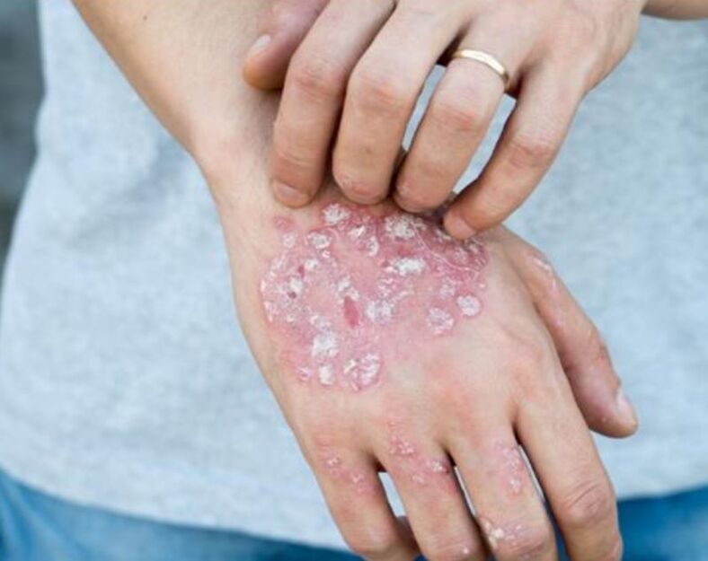 psoriasis in the hands of a man
