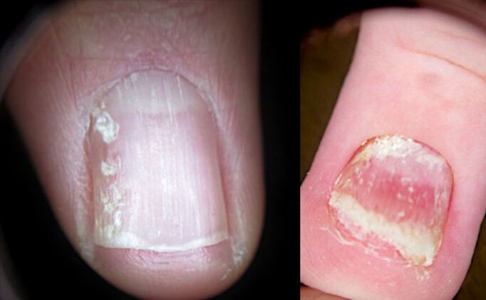 Crushed nails with psoriasis