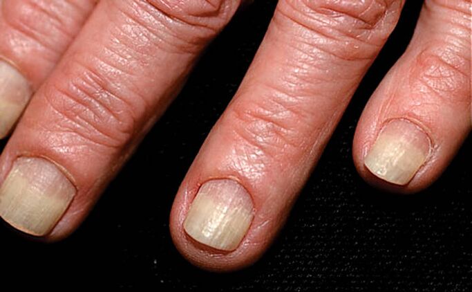 Propagation of onycholysis from the edge of the nail to the nail fold