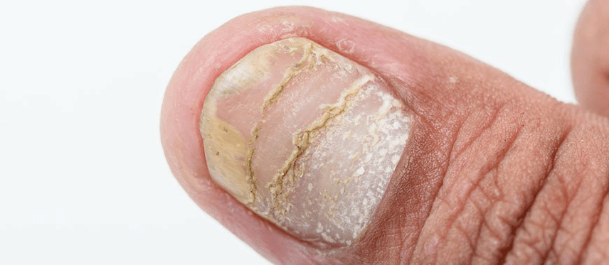 acute form of nail psoriasis complications