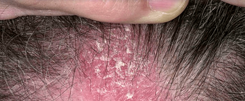 scalp skin lesions with psoriasis